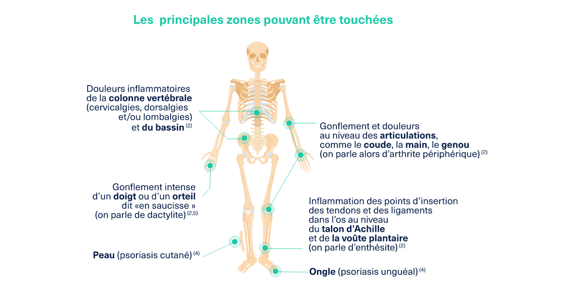 Rhumatisme psoriasique